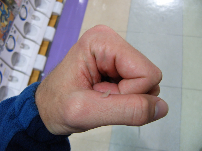 Blister of awesomeness!